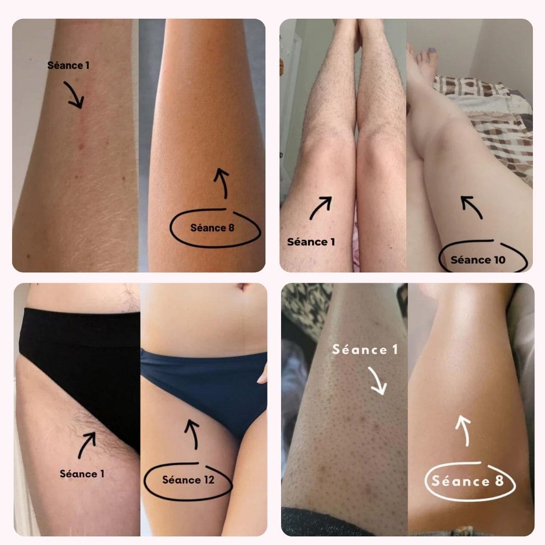 Épilateur à Lumière Pulsée